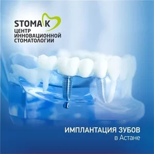 Имплантация зубов в Астане- в инновационной стоматологии Stoma-K! 
